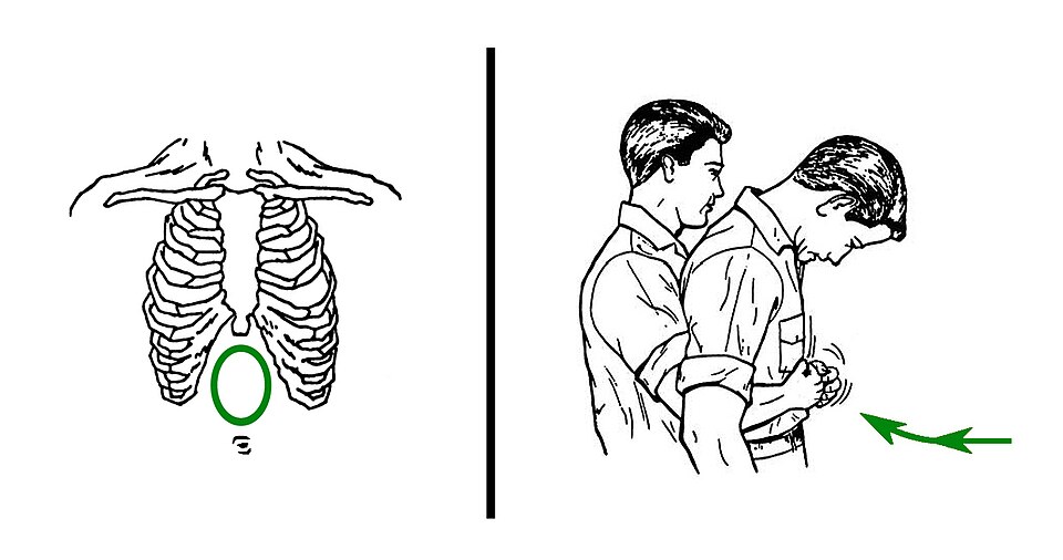 Helping a Choking Adult