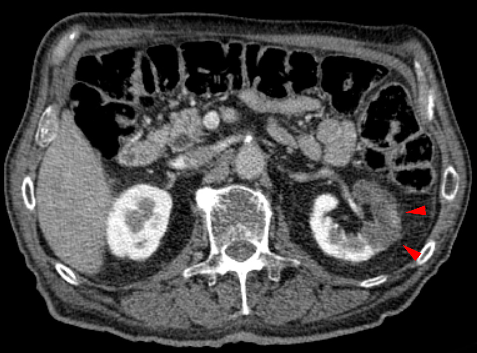 How Diverticulitis Is Diagnosed