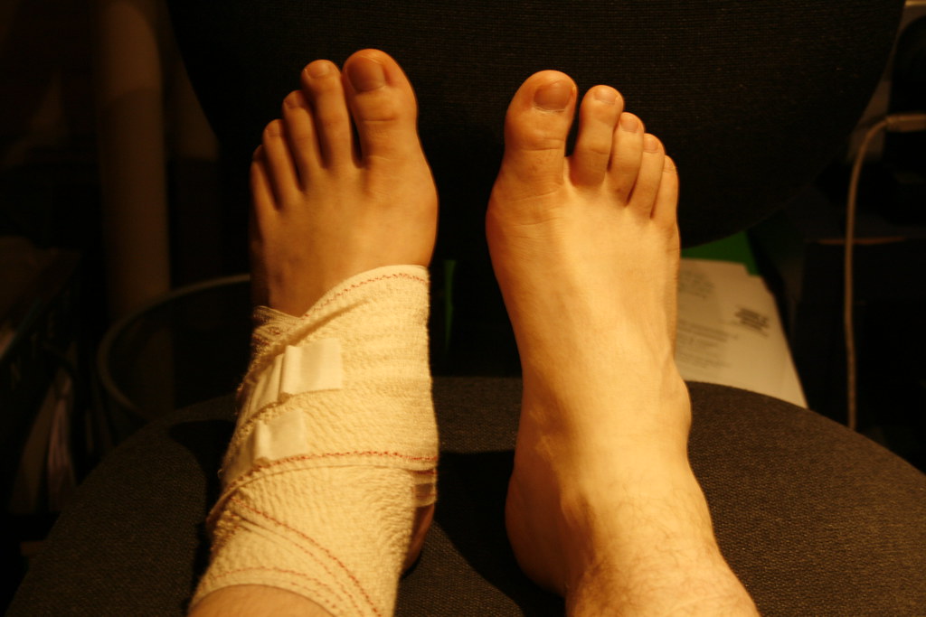 Treating Sprains and Strains
