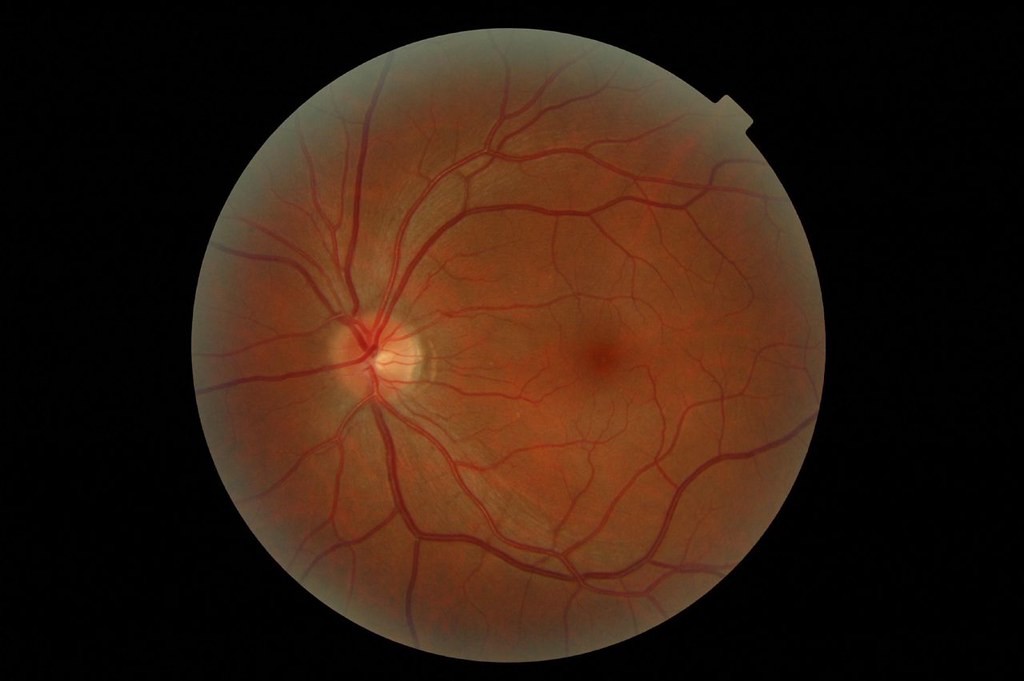 Why Yearly Eye Exams Matter With Diabetes